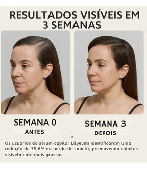 Lilyeve Hair Growth - Sérum Capilar Coreano com Exossomos 100ml