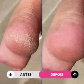 Soft Feet Pro - Lixa de Pé Elétrica Portátil Removedor de Calos e Rachaduras