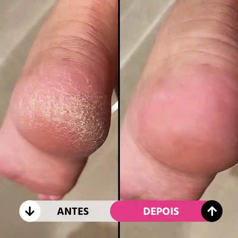 Soft Feet Pro - Lixa de Pé Elétrica Portátil Removedor de Calos e Rachaduras