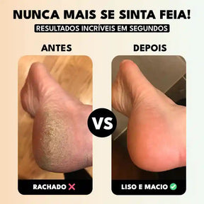 Soft Feet Pro - Lixa de Pé Elétrica Portátil Removedor de Calos e Rachaduras
