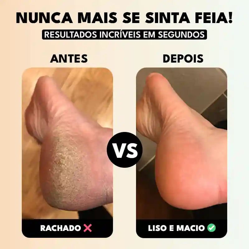 Soft Feet Pro - Lixa de Pé Elétrica Portátil Removedor de Calos e Rachaduras